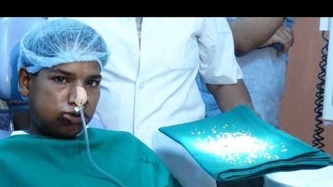 Extraccion de 232 dientes a un adolescente en la India